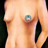 benelli breast augmentation