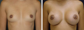 Miami Breast Augmentation Before and After Photos