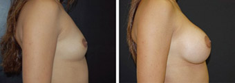 Miami Breast Augmentation Before and After Photos