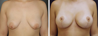 Before and After