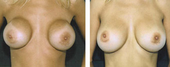 Before and After