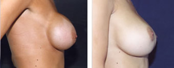 Before and After