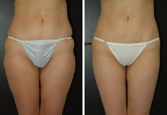 Before and After