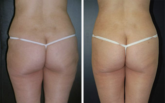 Before and After