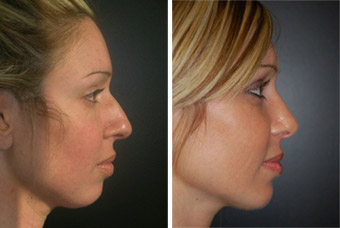Before after photo