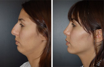 Before after photo