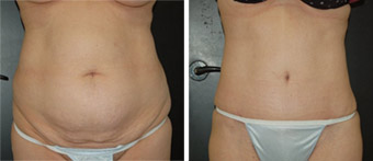 Before after photo