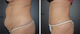 Before after photo