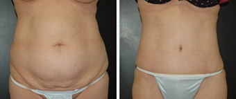Before and After