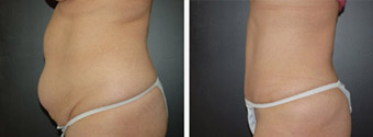 Before and After