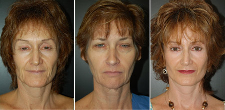 Before after photo