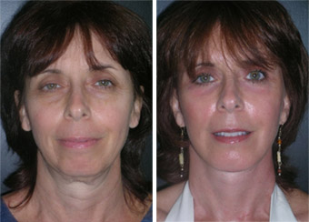 Before after photo