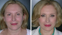 face lift Miami