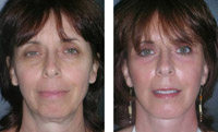 face lift Miami