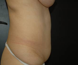 Tummy Tuck Before Side .jpg