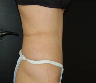 Tummy Tuck After Side .jpg