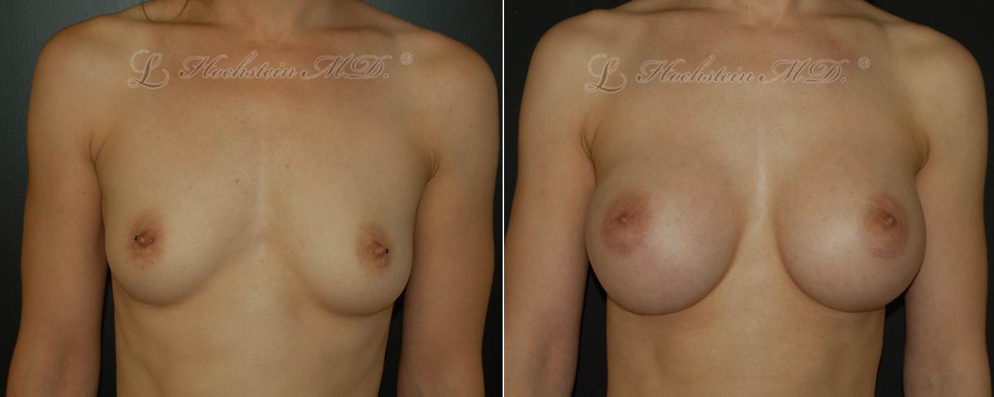 Boob groping and shaking Boob before and after photo