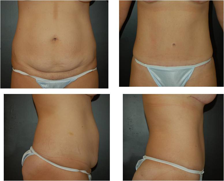 Tummy-Tuck-Before-and-After.jpg