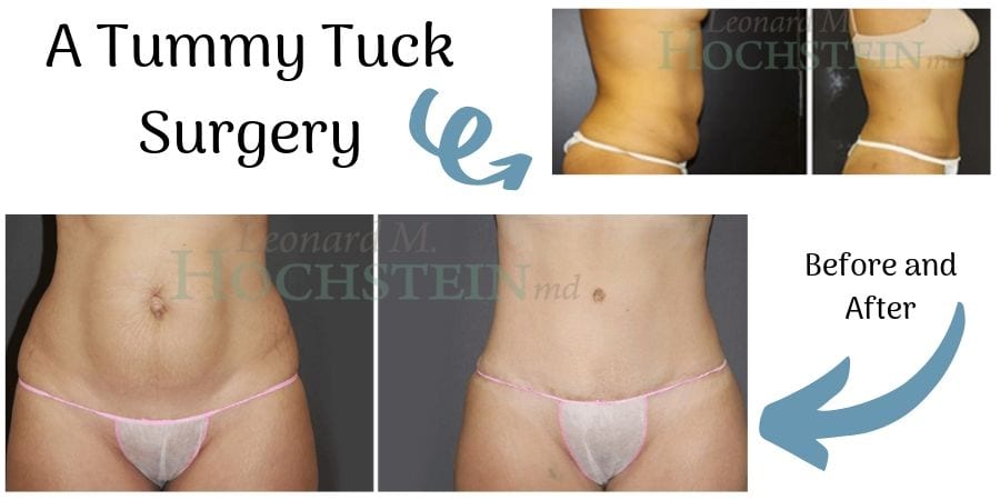 tummy tuck surgery transformation