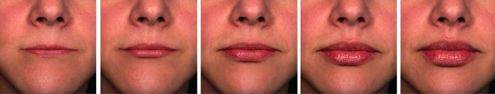 Lips with different volumes of injectable fillers