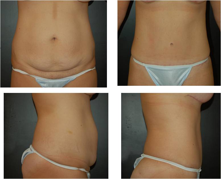 Tummy Tuck Before and After