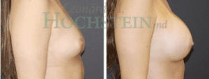 Breast Augmentation Before and After