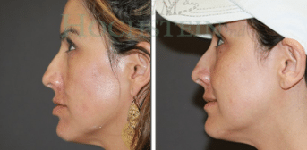 Laser Treatment Before and After Photos