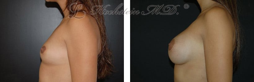 breast-augmentation-before-after-side