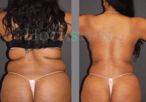 Dr. Hochstein - Liposuction