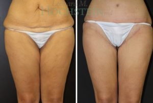 thigh-lift-02 by Dr. Hochstein