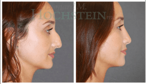 Hochstein Rhinoplasty Patient Before and After Photos