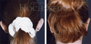 Hochstein Ear Pinning Patient Before and After Photos