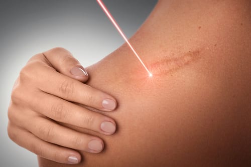 Woman Getting Laser Treatment on Shoulder Scar