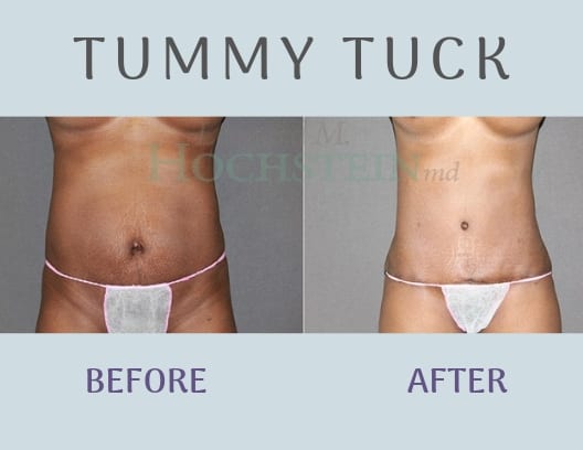 Tummy-Tuck-Patient-1-blog-ba-img