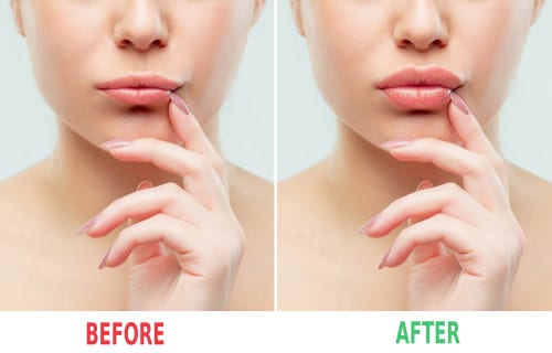 before and after lips filler injections-img-blog