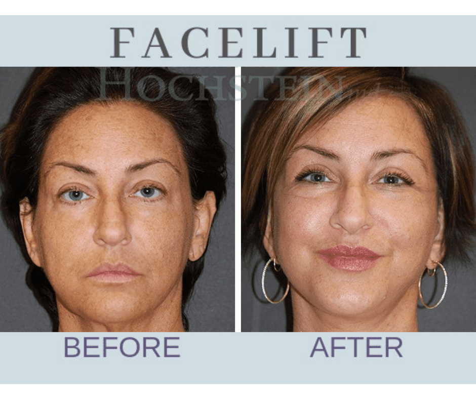 img-blog-face-lift-patient-03BA