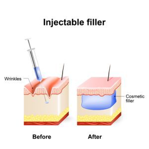 injectable cosmetic filler graphic-img-blog