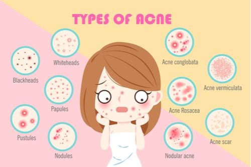 Acne can take several different forms, shapes, and sizes, but it never ceases to make us feel self-conscious. Practicing good skincare habits and using the proper products on a consistent basis can help manage and prevent acne from occurring.