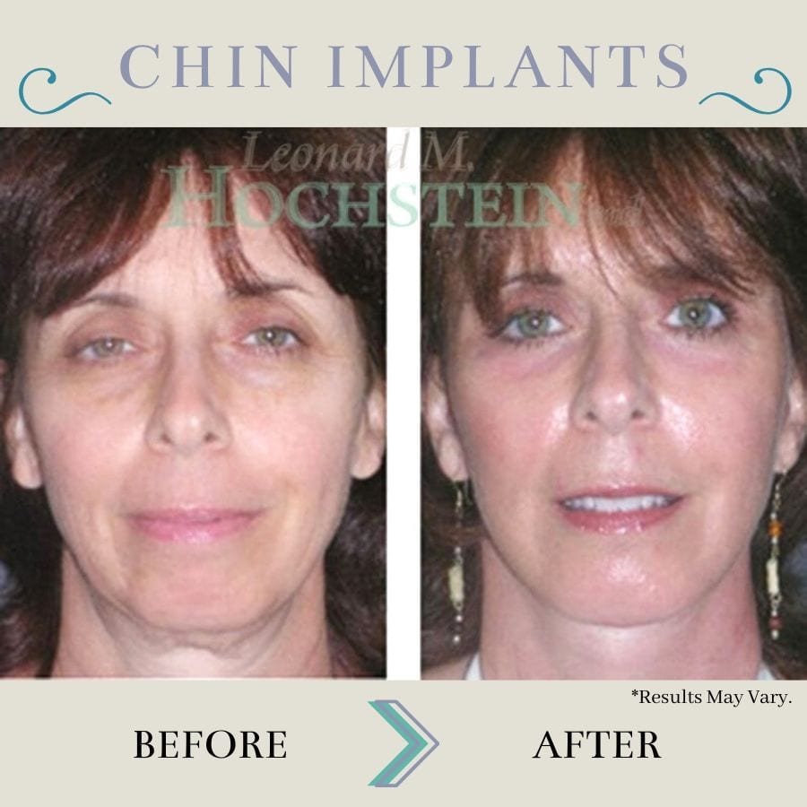 This before-and-after image set shows how chin implants lead to an overall more defined appearance. By shaping and contouring the chin, the rest of the face looks younger and better balanced.