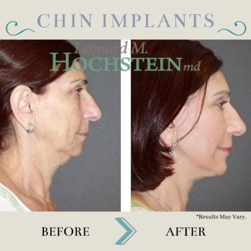 These before-and-after images show the difference chin implants can make in a woman's facial profile. Chin implants can make the chin look fuller and more contoured, balancing other facial features.