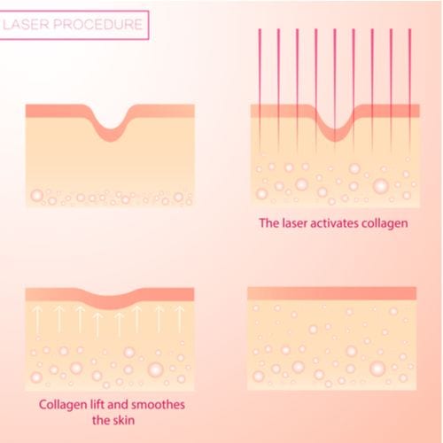 Laser treatments use specialized light beams to gently penetrating the skin’s surface and boost its regenerative properties, as shown in this diagram. Collagen production is activated, creating new skin cells and improving skin.