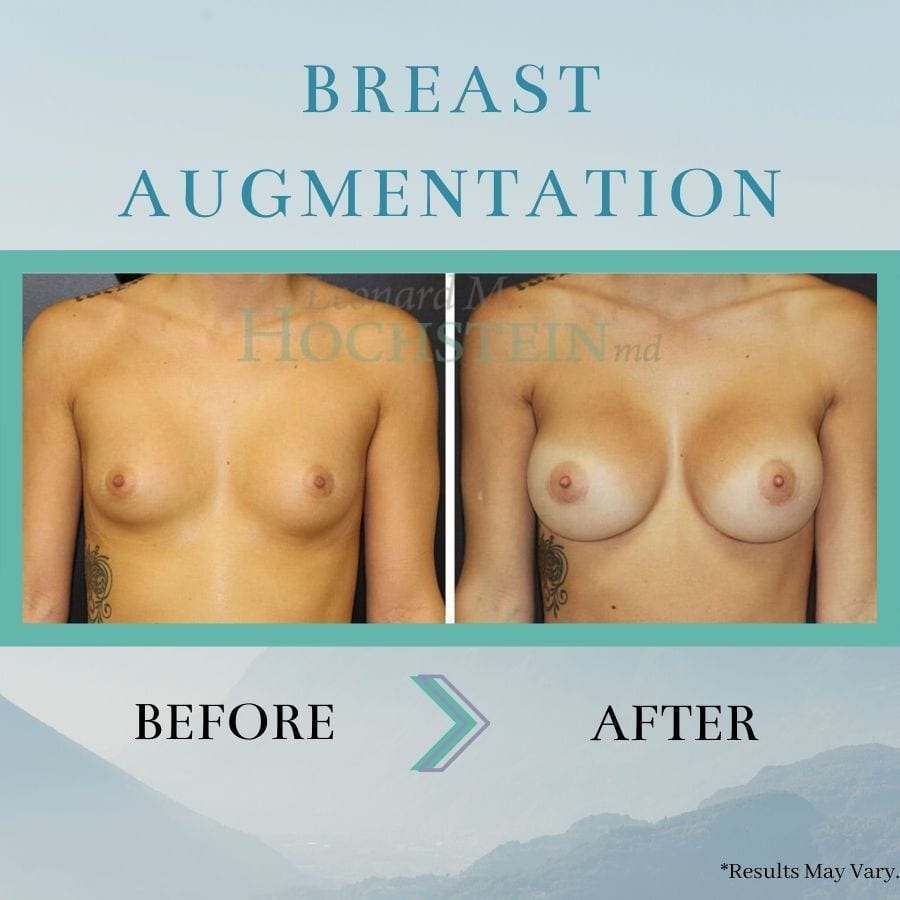 before-and-after-breast-augmentation-breast-aug-02736-17a