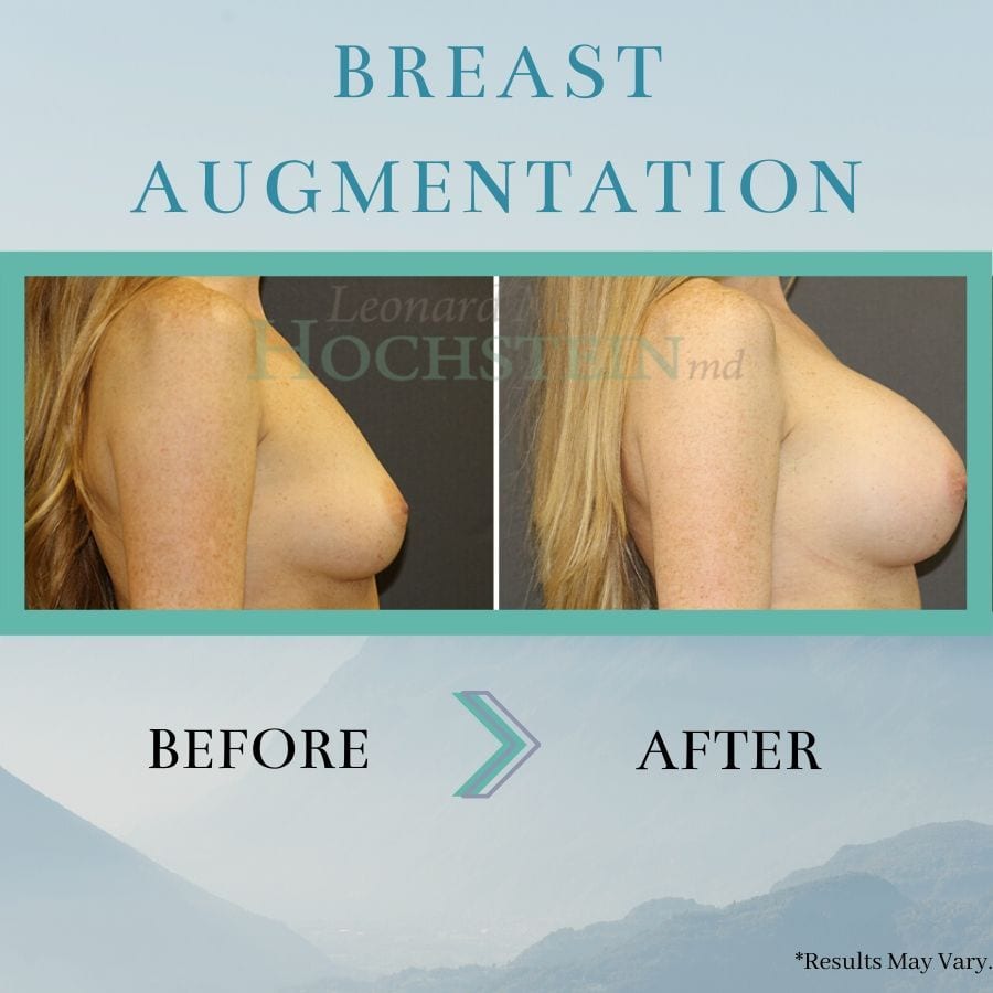 before-and-after-breast-augmentation-breast-aug-p253-b