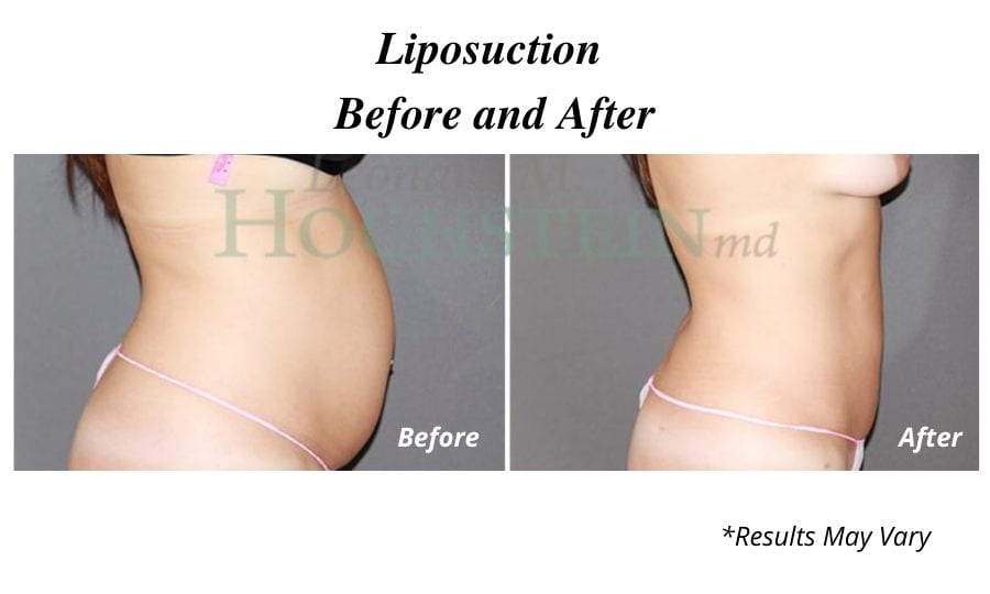 Before and after of a woman's liposuction results