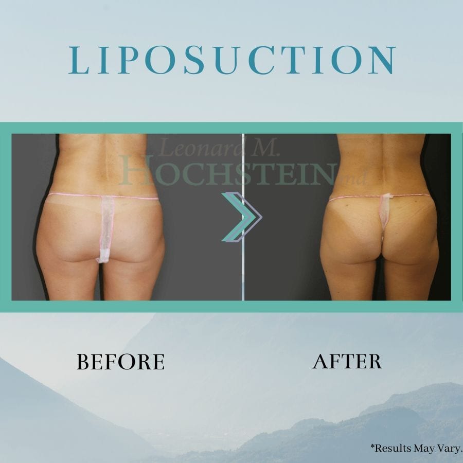 before and after liposuction 