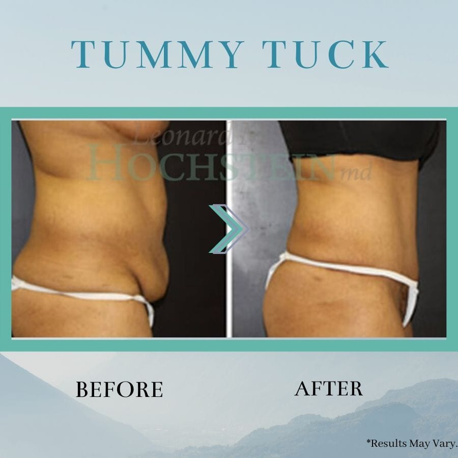 Before and after images of tummy tuck surgery