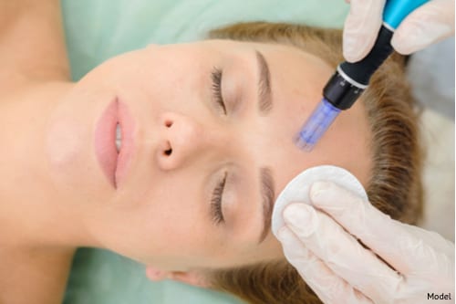  Woman undergoing a microneedling treatment-img-blog