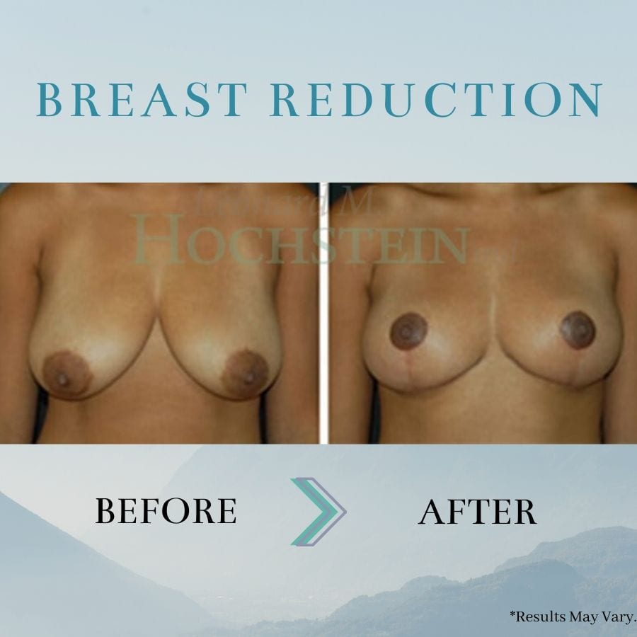 breast augmentation before and after 