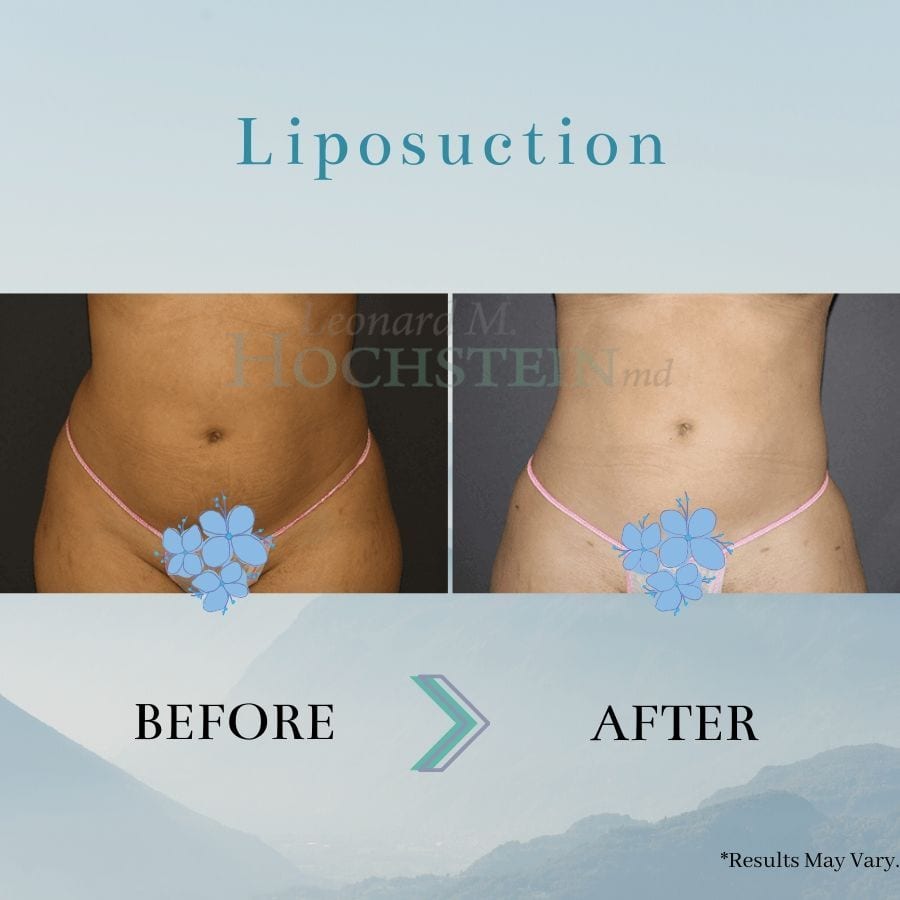 Woman who has enhanced the contours of her stomach with liposuction