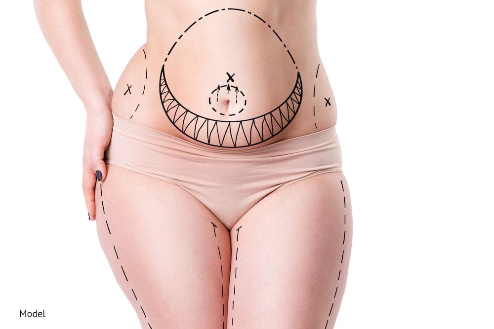 woman with stubborn fat who is going to get a liposuction procedure.
